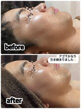 ヴィー(VII)/メンズフェイシャルbefore after