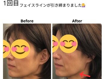 ベル/50代の方の小顔Before After