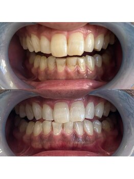 おうちサロン しゅろ/プレミアムセルフホワイトニング