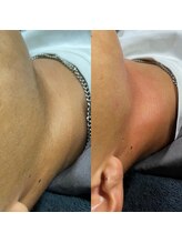 ティグレ 岡山店(TIGRE)/フェイシャルWAX脱毛