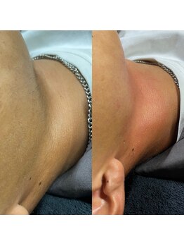 ティグレ 岡山店(TIGRE)/フェイシャルWAX脱毛