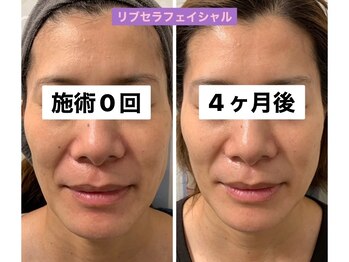 プリュネル(Prunelle)/プラズマシャワー