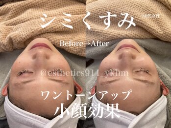 エステティックス ナインワンワン 横浜(Esthetics911) /シミくすみ改善