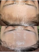 レシェルサロン(Lechelle Salon)/ハーブピーリング＋ダーマエステ