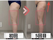 イヨヨ(iyoyo)/【痩身】Before After