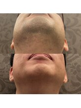 フェリーバ(FELIVA)/Before&After