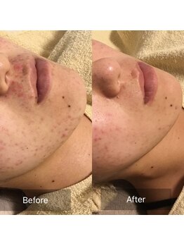 ファヴォリ(favori)/美白美容液導入