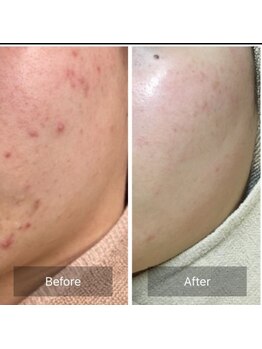 ココ 梅田中津(COCO.)/ニキビケア＊ハーブピーリング