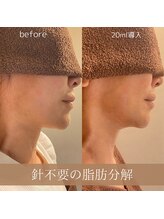 サンポ 神戸元町店(SANPO)/20ml導入