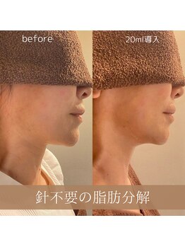 サンポ 神戸元町店(SANPO)/20ml導入