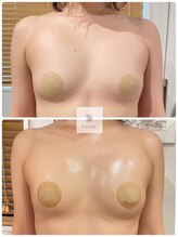 エムクリニカルラボ 藤沢(M clinical lab)/脂肪増加剤導入バストアップ