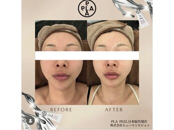 モンスリール 麻布十番(Mon Sourire)/プラピール+幹細胞100%