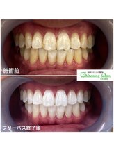 ホワイトニングサロン 名古屋駅店/【ホワイトニング施術例】