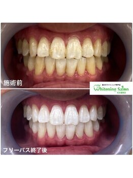 ホワイトニングサロン 名古屋駅店/【ホワイトニング施術例】