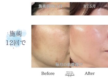 ディアスマイル(Dear.smile)/施術12回で