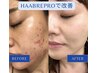 【本気の肌質改善】最速で極上艶肌へ HAABREPROホームケア付 ¥26510→¥13900