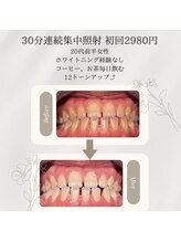 プラスビーセルフ(+b self)/ホワイトニングビフォーアフター