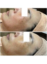 リッツ 所沢店/【Before/After】しみ改善