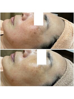 リッツ 所沢店/【Before/After】しみ改善