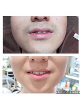 サロン ド スー(Salon de Suu)/脱毛（ヒゲ）