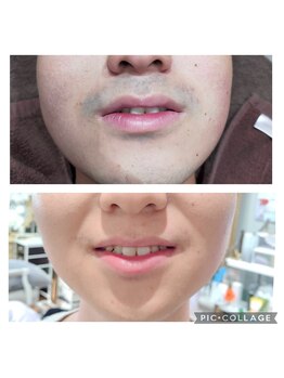 サロン ド スー(Salon de Suu)/脱毛(ヒゲ)