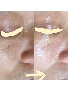 シエスタ 新小岩/お肌のくすみをクリアに♪