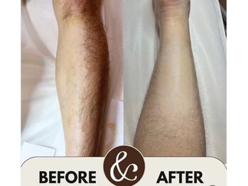 エムディーエス 新宿御苑(MDS)/W脱毛でツルスベ肌へ♪