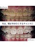 【矯正中の方必見☆】美白セルフホワイトニング40分照射¥3300
