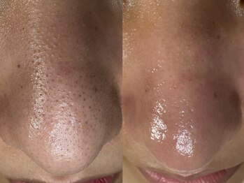 サラグランデ(Sara Grande)/毛穴の定期メンテで美鼻維持♪