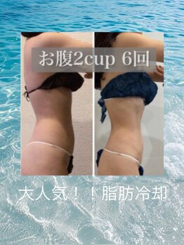 プリマプリート 各務原店の写真/【最強痩身!脂肪冷却2cup¥8800】ノーリバウンドでホディメイク♪はみ肉、内もも、頑固な二段腹もお任せ★