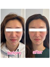 ヴィヴィアナ(viviana)/中顔面を短くしたい！