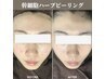 【口コミ限定】最強肌質改善！幹細胞ハーブピーリング3回券9900円！
