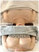 美人バスト 福岡店/バストアップ ◇症例◇