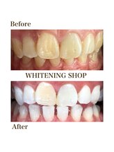 ホワイトニングショップ 一関店/9回照射後のbefore→after