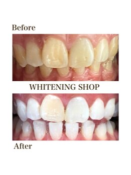 ホワイトニングショップ 一関店/9回照射後のbefore→after