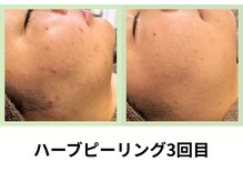 シェリール(Cherir)の雰囲気（ハーブピーリング☆2週間以内のご来店でご新規価格で通える◎）