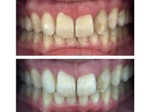 ホワイトニング美白ラボ 筑西店(ホワイトニング美白LAB)/