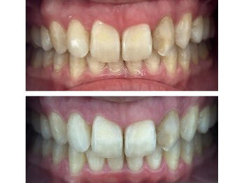 ホワイトニング美白ラボ 筑西店(ホワイトニング美白LAB)/