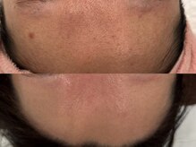 ベアール(beal)/毛穴特化ハーブピーリング4回