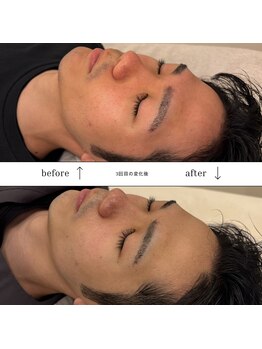 リ肌 天王寺店(Re肌)/ララピールのビフォーアフター