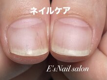 イーズ(E's)/深爪特化ケア