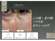 シェリー(Cherie)の雰囲気（気になる額の凹凸、目の下の凹凸悩みも改善【小顔/広島/たるみ】）