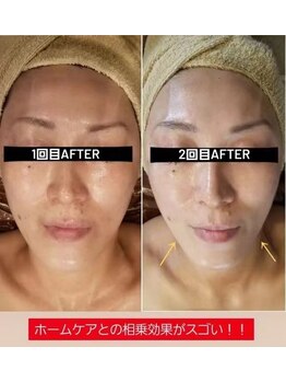 サロン ド レイ(Salon de Rei)/陶肌REVIハーブピーリング