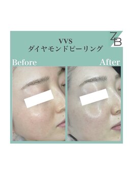 ザラハビューティー(ZARAHA Beauty)/VVSダイヤモンドピーリング