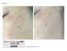 【年齢肌のお悩みに】光フェイシャルでシミ,たるみケア+肌別モデリングパック