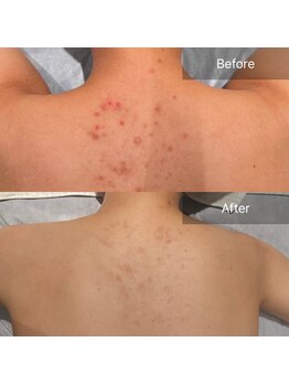 ルナスーリヤ 仙台店/ハーブピーリング