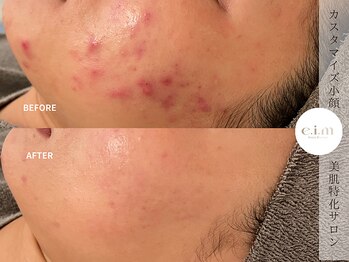 エイム(e.i.m)/20代：ニキビ/赤み