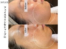 ヴィタベラ(Vita Bella)/WINBACKフェイシャル+ラミピ