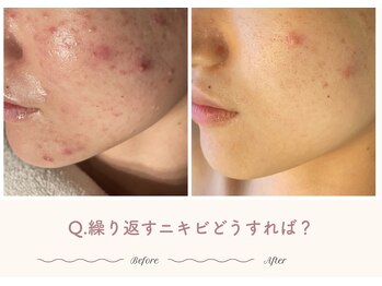 エステティックサロン シーズ/Q.繰り返すニキビどうすれば？