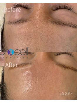 レア(le'a)/長年の毛穴の悩み